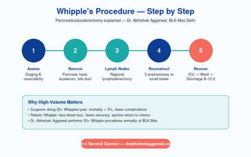 Whipple's Procedure (Pancreaticoduodenectomy) — clinical infographic by Dr. Abhishek Aggarwal